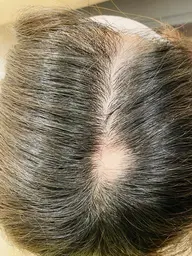 【育毛鍼】薄毛／円形脱毛症の施術モニター募集（92%OFF）