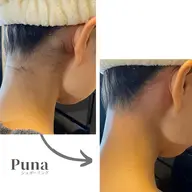 女性【シュガーリング】うなじ脱毛