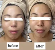 小顔トリートメント体験​〜​短時間で実感、肌が若々しく​〜​最新機#テラボーラー