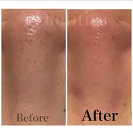 【気になる鼻周りの角質・角栓をごっそり解消✨】『鼻周り3D毛穴吸引＋最新ハイドロジェリーマスク（鼻）』