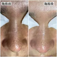 【毛穴洗浄】黒ずみ・詰まり・開き毛穴改善