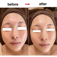 人気No.2✨ハーブピーリング🌿80分//ビタミンCまたはヒアルロン酸導入付き/デコルテマッサージ付き