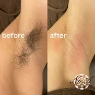脇ダブル脱毛【女性5,000円、男性7,000円】