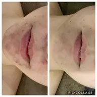 ★モデルニコルちゃんやみちょぱも絶賛♪大人気剥離なしハーブピーリング★様々なトラブルから開放！一気に肌再生♪