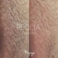 【最新メラニンケア/Mipyu】VIゾーン/アフタークリーム1ヶ月分付