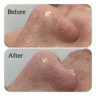 ✨ハイドラフェイシャル毛穴洗浄✨毛穴詰まり・黒ずみスッキリ✨