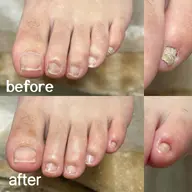 足の爪切りケア