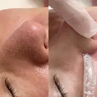 期間限定❗️韓国式3D毛穴洗浄