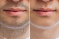 【メンズ】【WAX脱毛】口周り