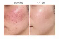 【ニキビ・赤みでお悩みの方】スキンメイド