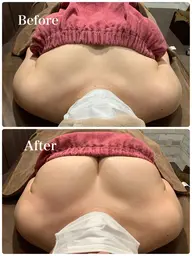 【ミニモ限定価格！1日1名限定】左右差離れ胸撃退！ふわふわっお椀型バスト💗　通常35000円→5800円