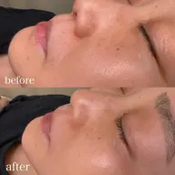 🪞【顔脱毛】お顔の産毛をスッキリ取り除く