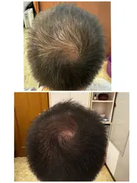 【薄毛改善施術】￥3300→￥3000