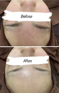 ニキビ肌最新のピーリングで韓国肌へ症例取らせてください‼️