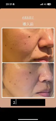 #成長因子導入トリートメント静岡で受けられるのは当サロンのみ！細胞から綺麗に毛穴やたるみ、シワ、くすみで悩む方必見👏