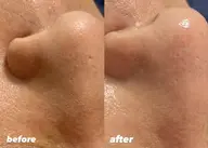 1✨大バズり中毛穴洗浄 ✨【最先端毛穴サヨナラ】ハイドロフェイシャル毛穴洗浄14,000→6,600