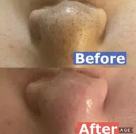 🐻💕話題のアクアピーリング2回🐻💕水光ツヤフェイシャル💕流行のピーリングをお得に体験💕毛穴洗浄/くすみ/小顔