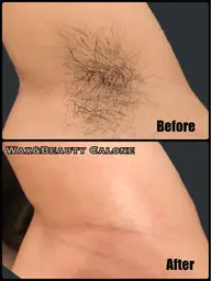 「レディース」ワキ光脱毛