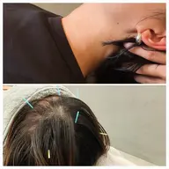 鍼のヘッドスパ