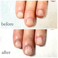 深爪ケアコース