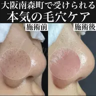 【初回限定90分の毛穴ケア】エクストラクションで毛穴改善！黒ずみ・ザラつき撃退！南森町駅徒歩5分✨