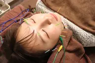 🎉おすすめNo.1🎉【エラ・くいしばり特化メニュー】電気美容鍼＋本数アップ＋フェイスマッサージ＋首肩背中マッサージ