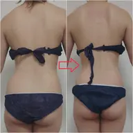 🉐【痩身人気No.1】今すぐ痩せたい!綺麗になりたい方✨ハイパーナイフ痩身100分×3回※条件アリ