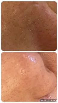 水素毛穴洗浄and小鼻むくみケア