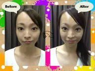 上田式美容鍼灸®️