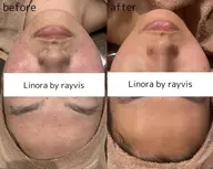 当店人気メニュー🌈【🌿剥離ありハーブピーリング🌿】早く改善したいお肌悩みに🍀即効性重視な方向け🌟本格肌質改善❗