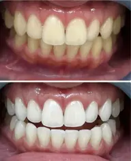 【初回ご新規様限定】ハイパワーコース​〜​超集中照射​〜​　15分×3照射