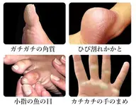 【オプション】魚の目/角質除去