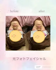 光エステ💆‍♀️しみ、しわ、むくみ、赤ら顔、にきび、ほうれい線、たるみにアプローチし、小顔効果抜群です🎀
