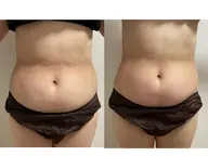 《痩身都度払い》美くびれ引き締めコース