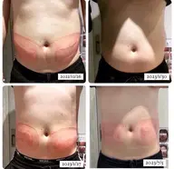 クールスカルプティング