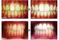 ◆セルフホワイトニング◆ 2セット