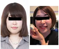 【新規限定】黒いプツプツさようなら‼️毛穴スッキリコース✨ちゅるちゅる肌✨