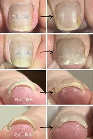 痛くない巻き爪解放🦶🏻✨両親指２本分✨フットバス付き🛁