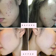 【韓国フェイシャル】本気の肌質改善!!