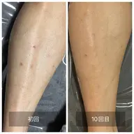 【短パン履いた時の清潔感up!メンズ脱毛】脚まるっと脱毛 ¥5000