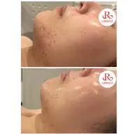 お試しハーブ💚ྀི今話題の❣️剥離しないハーブピーリングで細胞からケア🌿ニキビ･ニキビ跡･毛穴あらゆる肌を改善