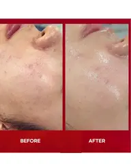 韓国白玉ピーリング