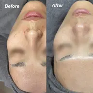 スペシャルケア✨【毛穴洗浄+ピーリング】✨