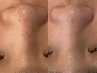 顔脱毛＋ハイドラ毛穴洗浄