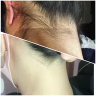 レディース 【うなじ脱毛】 うなじスッキリで首長く、小顔効果✨️！