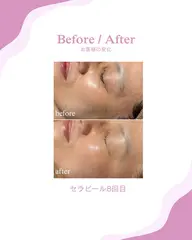 【最新】韓国肌管理×毛穴洗浄