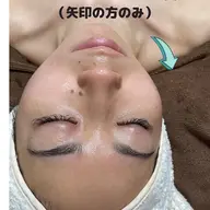 光フェイシャル+フェイシャルマッサージ