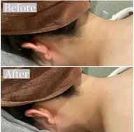 【気になる箇所★】えりあし脱毛体験　他店では無くせない、髪の毛無くせます✨　2種類の機械を使って太い毛​〜​産毛に対応⭕️