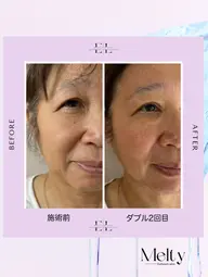 ExoLift【エクソリフト】