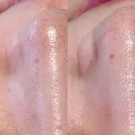 【激推し】話題の肌育成ハーブピーリング［1箇所］🌿一回でも効果実感✨※翌日以降メイク可能